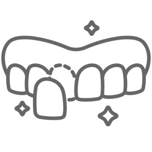 Composite Veneers